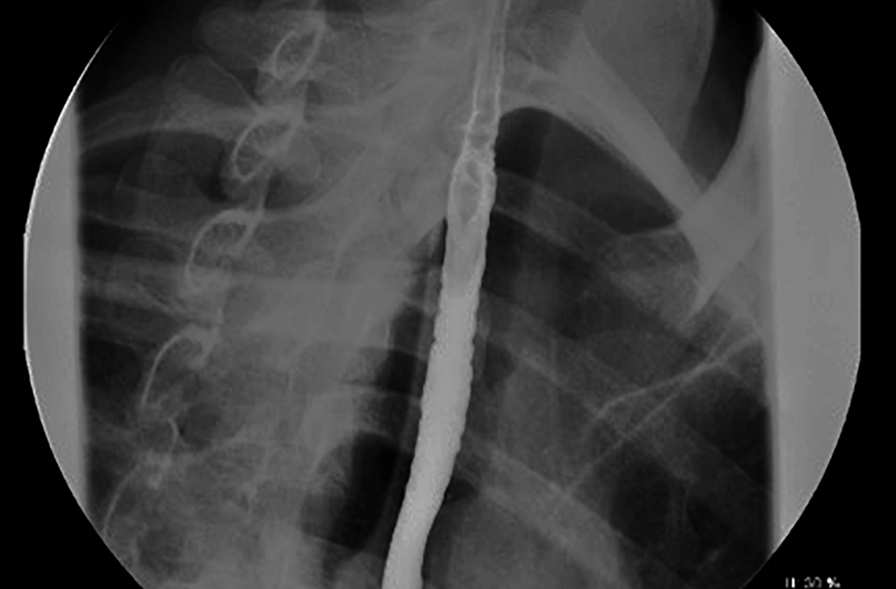 a stricture in the esophagus caused by eosinophilic eosinophilia